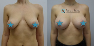 Breast augmentation 375cc anatomical implants