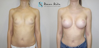 Breast augmentation wtih 330&295cc teardrop implants
