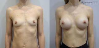 Breast augmentation wtih 295cc teardrop implants