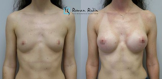 Breast augmentation 280cc anatomical implants