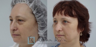 Upper and lower (subciliar approach) blepharoplasty