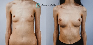 Breast augmentation 230cc anatomical implants