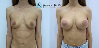 Breast augmentation wtih 350cc round implants