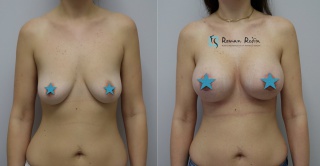 Breast augmentation 350cc round implants