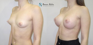 Breast augmentation wtih 330cc teardrop implants