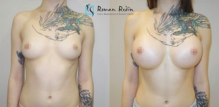 Breast augmentation wtih 400cc round implants
