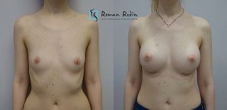Breast augmentation 350cc anatomical implants
