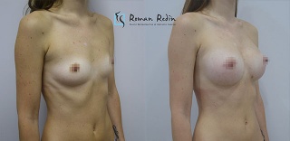 Breast augmentation 305cc anatomical implants