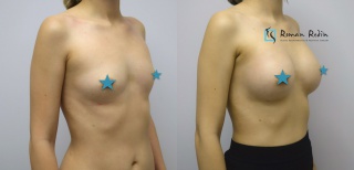 Breast augmentation 270cc anatomical implants