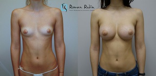 Breast augmentation 295cc anatomical implants