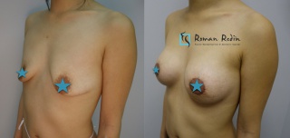 Breast augmentation 225cc anatomical implants