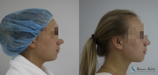 Bishat’s fat pad removal and liposuction of lower third of face and neck