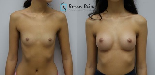 Breast augmentation 205cc anatomical implants