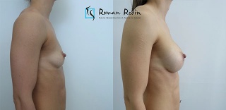 Breast augmentation wtih 300cc round implants