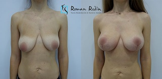 T-inverted breastlift with 300cc round implants
