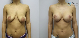 T-inverted Mastopexy with 300cc round implants
