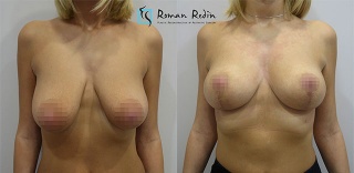 T-inverted breastlift without implants