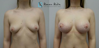 Breast augmentation 330cc anatomical implants