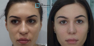Closed rhinoplasty